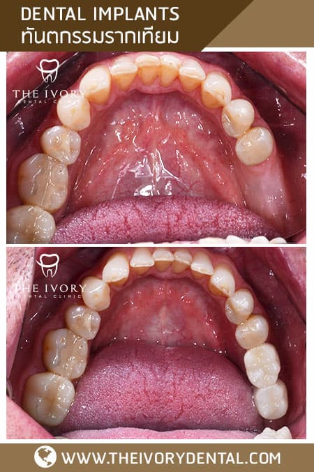 Dental implant cases 3