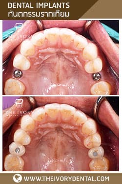 Dental implant cases 