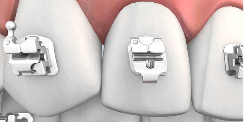 จัดฟันแบบโลหะติดแน่น - The Ivory Dental Clinic