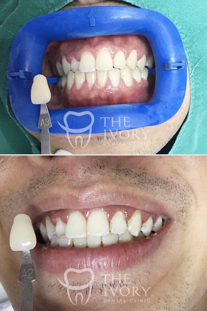 Dental Whitening 1