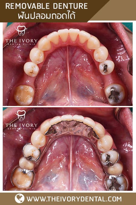 Dental veneers 1