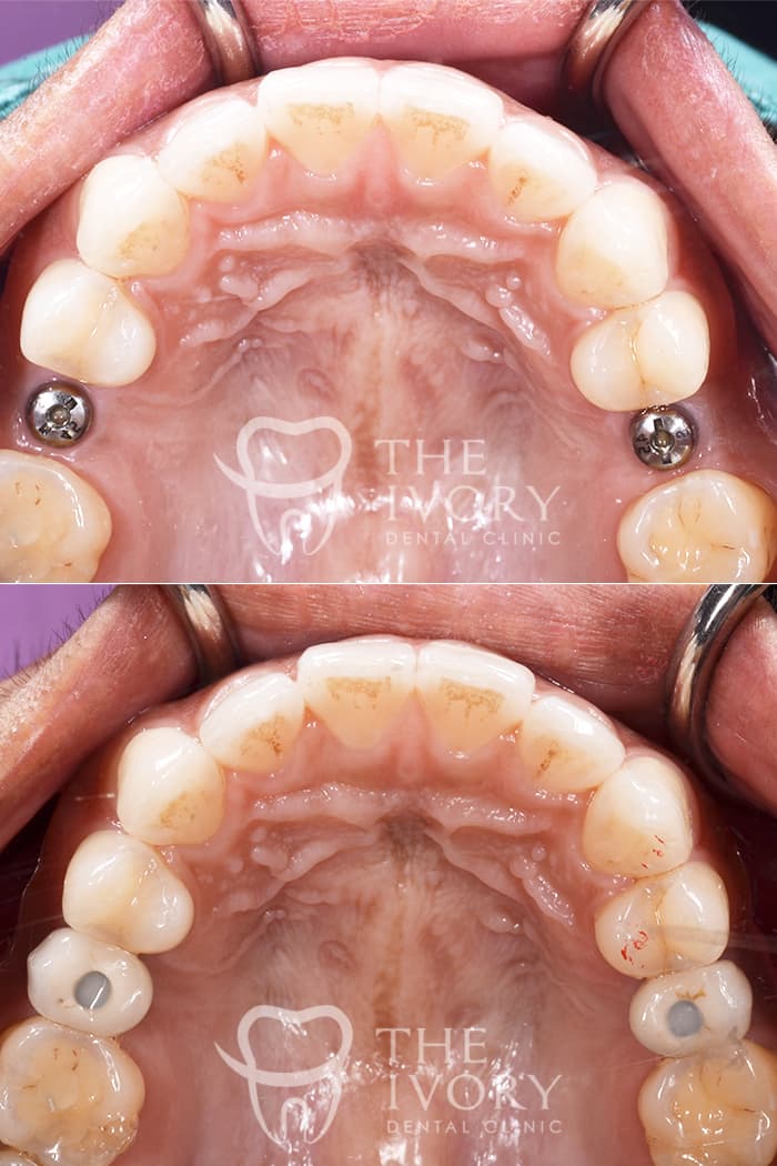 Dental implant cases 1