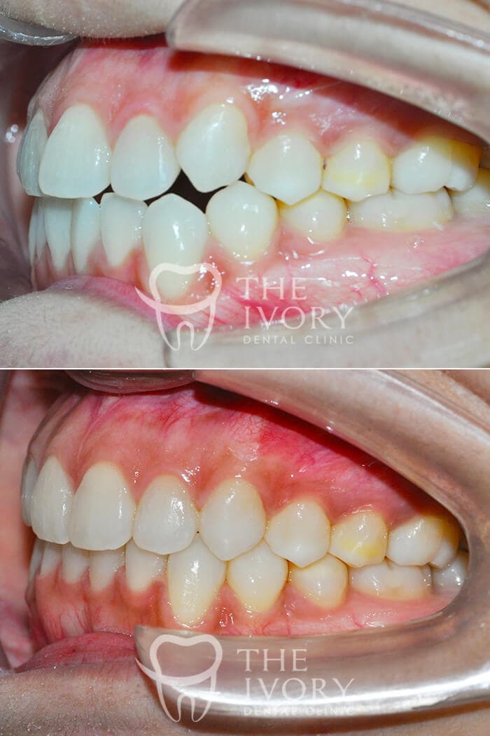 Dental veneers 2