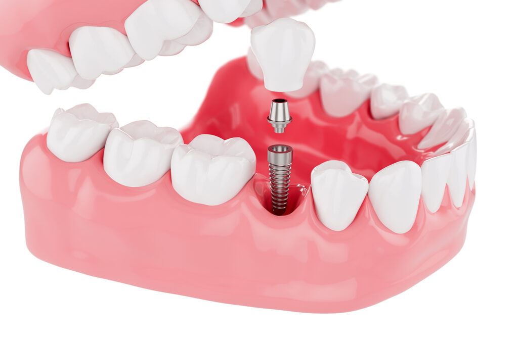 การทำรากฟันเทียม คืออะไร? - The Ivory Dental Clinic
