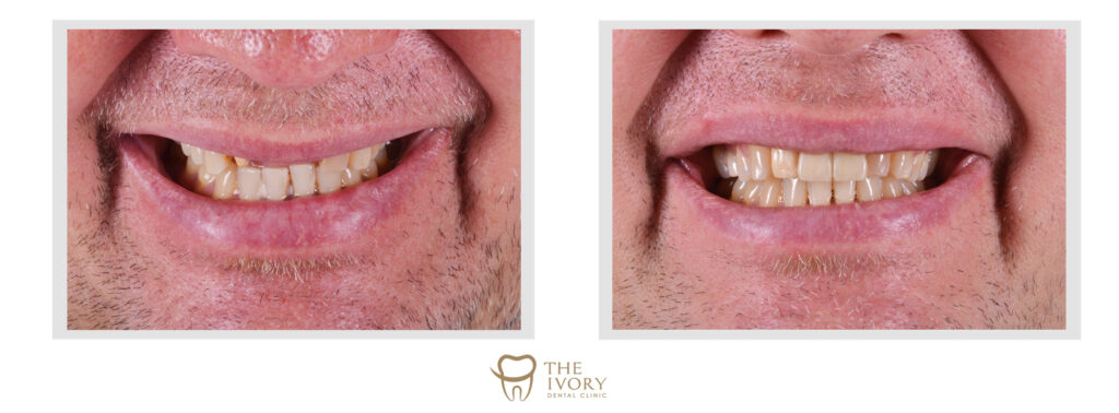 ยิ้มได้มั่นใจกว่าเดิมด้วยการทำรากฟันเทียม - The Ivory Dental Clinic