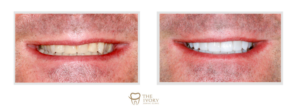 เผยรอยยิ้มใหม่ อวดความมั่นใจอย่างไร้กังวล - The Ivory Dental Clinic