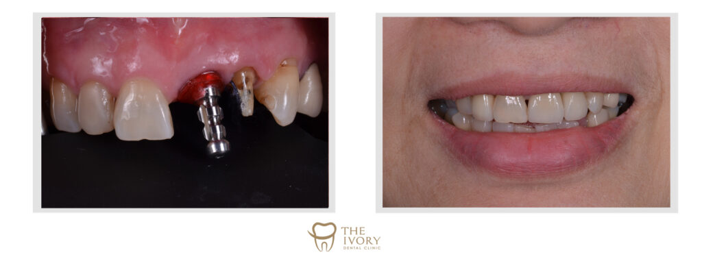 ยิ้มได้มั่นใจกว่าเดิมด้วยการทำรากฟันเทียม - The Ivory Dental Clinic