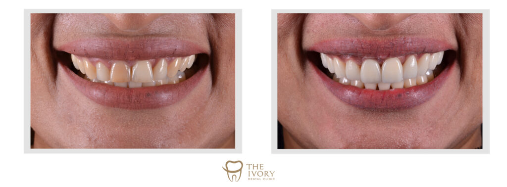 เผยรอยยิ้มใหม่ อวดความมั่นใจอย่างไร้กังวล - The Ivory Dental Clinic