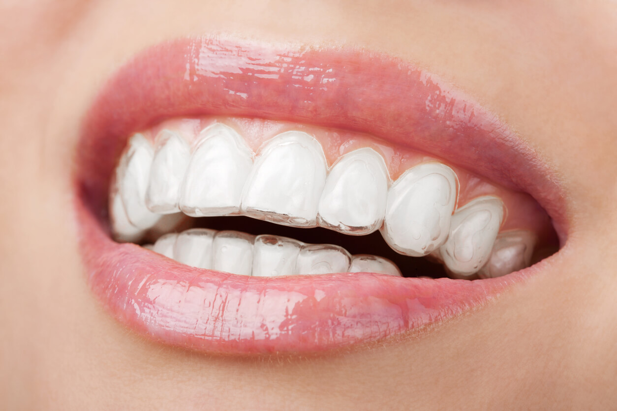 ยิ้มได้อย่างมั่นใจด้วยอุปกรณ์จัดฟันแบบใส Invisalign - The Ivory Dental Clinic