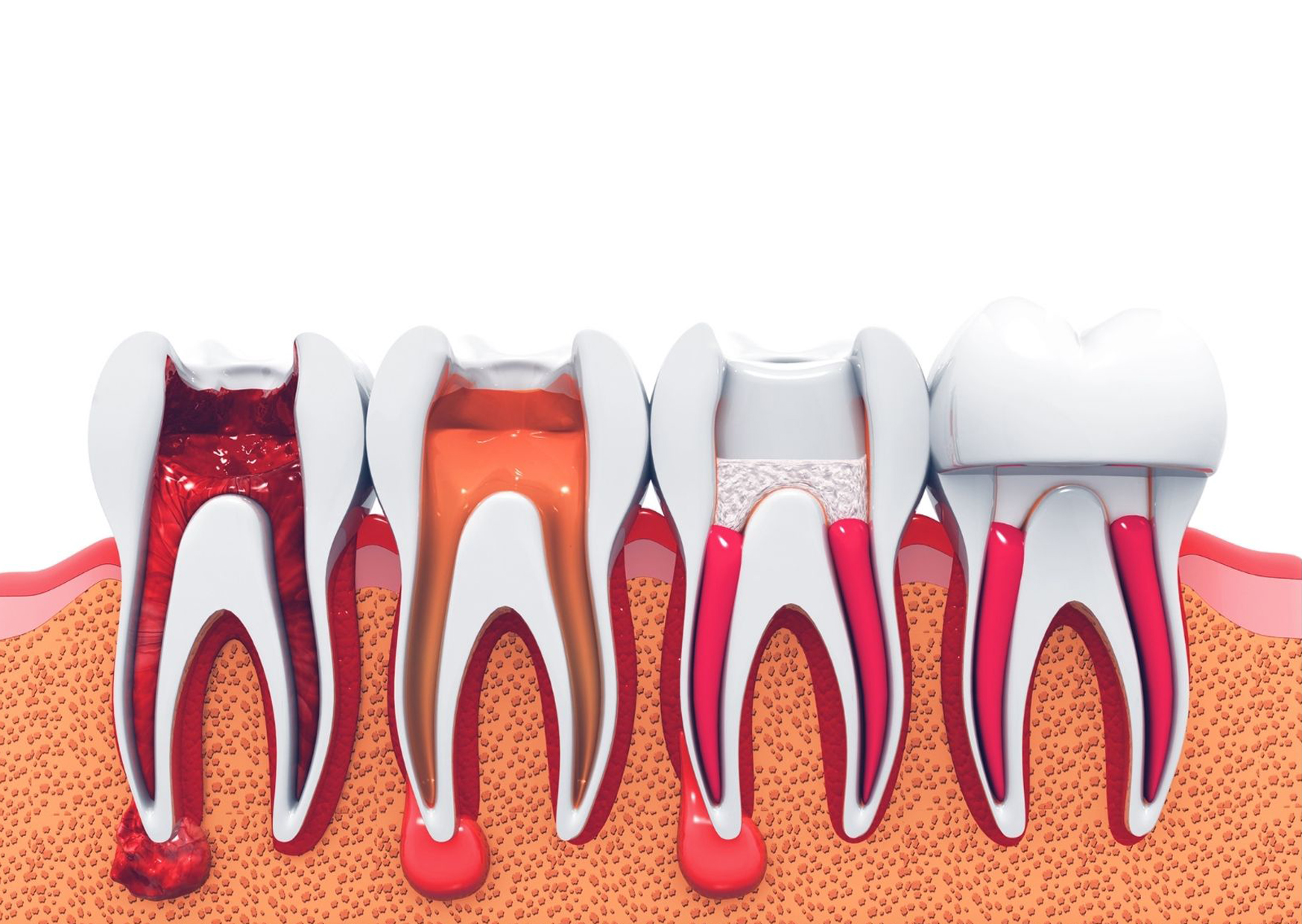 สาเหตุที่ทำให้รากฟันอักเสบ - The Ivory Dental Clinic