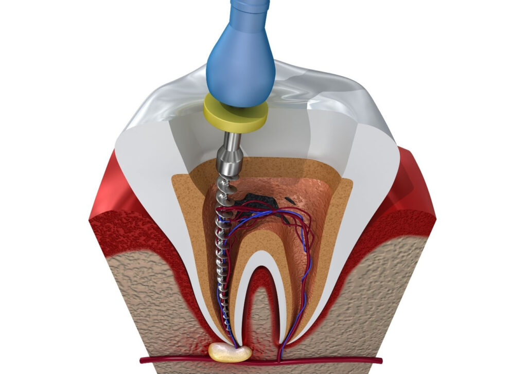 รักษารากฟันก่อน ไม่ต้องสูญเสียฟัน - The Ivory Dental Clinic