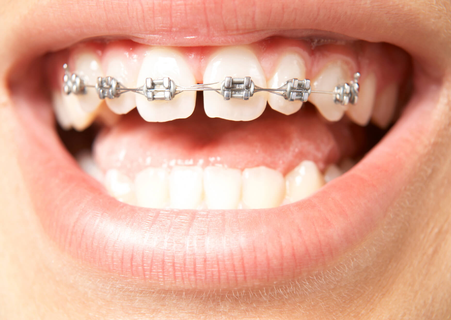 คลินิกทันตกรรมดิไอวี่-the-ivory-dental-clinic-จัดฟัน-ฟันซ้อนเก-ฟันห่าง
