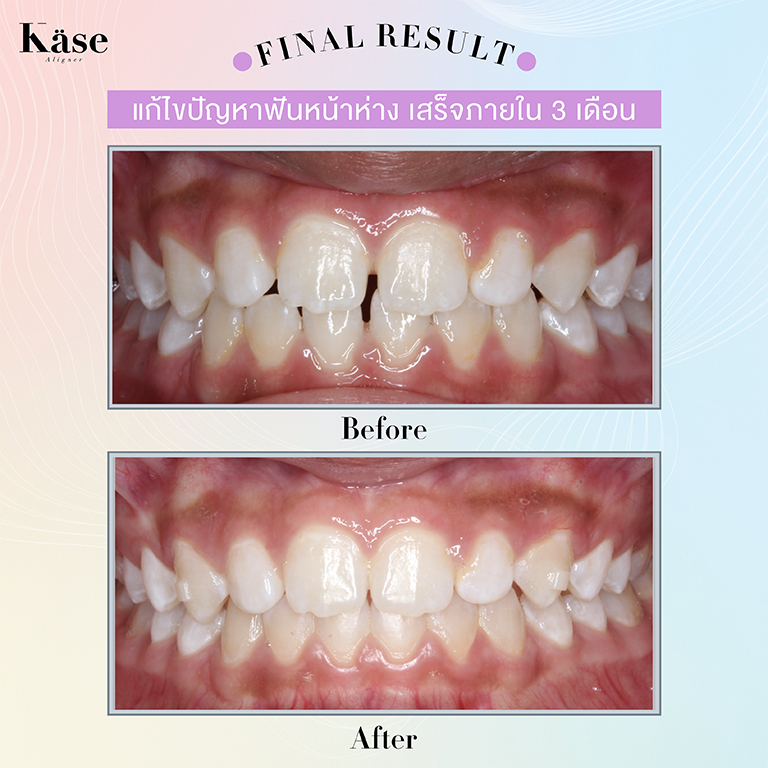 จัดฟันใส-จัดฟันแบบใส-kase-aligner-คลินิกทันตกรรม-ดิไอวรี่-รีวิว-5