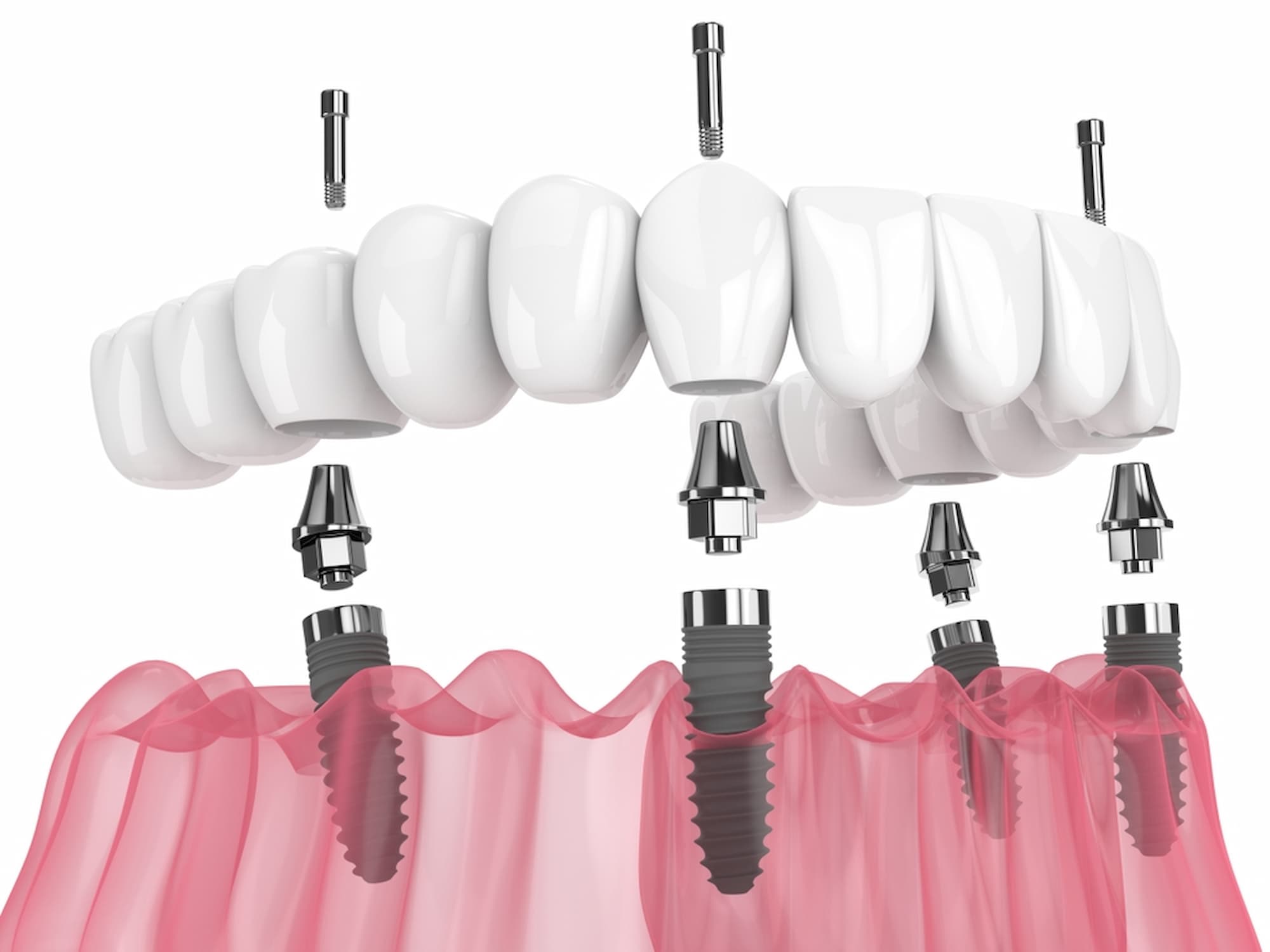 Dentures are popular teeth implants in Thailand.