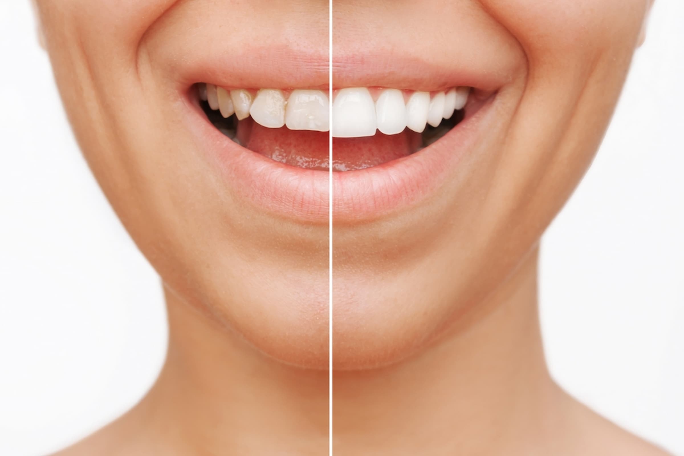 Get your dental veneers in Bangkok and improve your smile overnight.