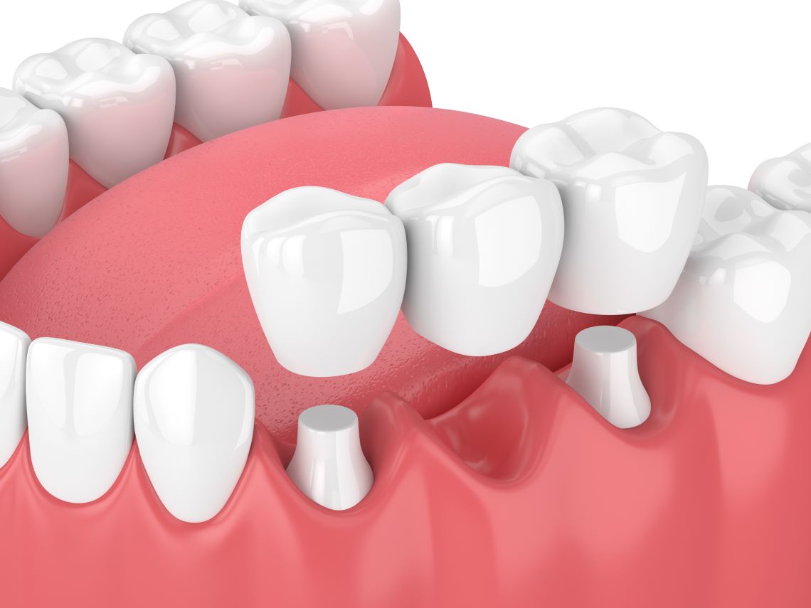 3D render of a jaw with a dental bridge over multiple teeth