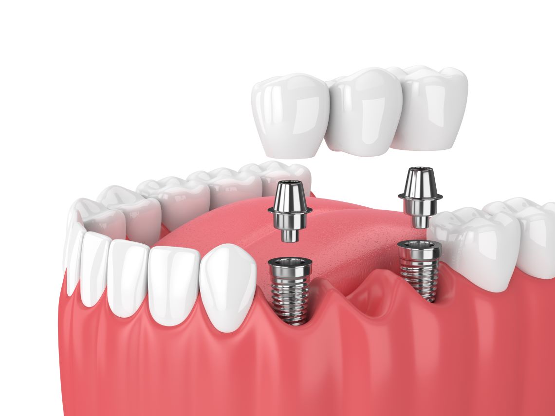 3D render of a jaw with dental implants over multiple teeth