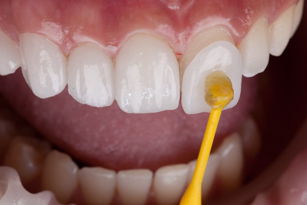Dental veneers can brighten a healthy smile