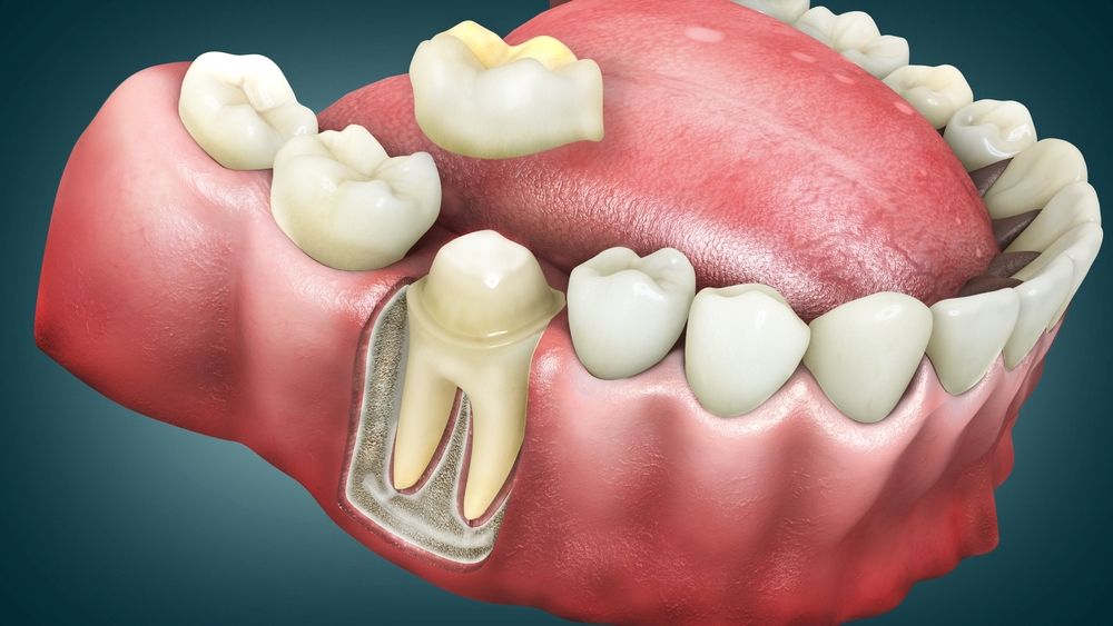 Example of dental crown installation for cracked tooth restoration.