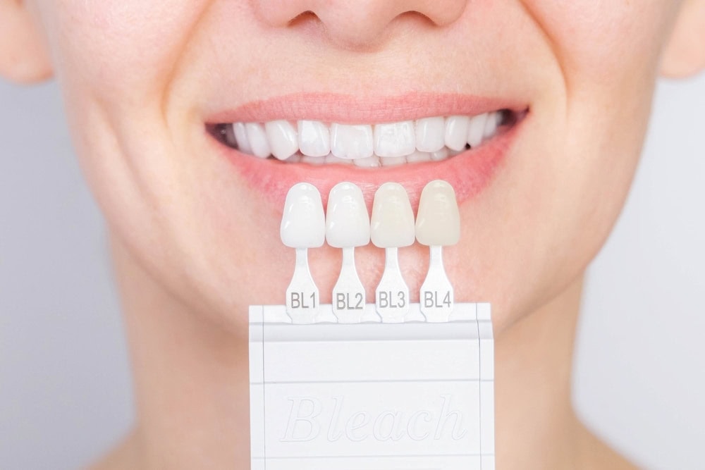 The benefits of dental veneers that help create a beautiful Hollywood smile.